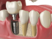 California Dental Group Montrose - www.cadentalofmontrose.com